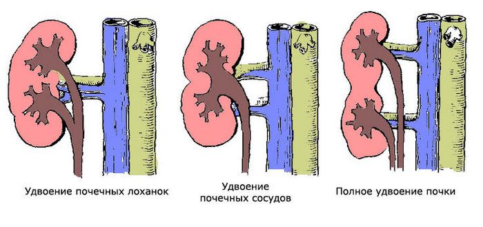 Удвоение почки фото