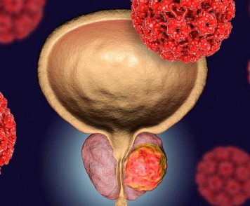 Инфекционный простатит