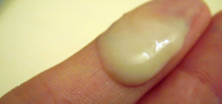 Фото: Патологические выделения из уретры